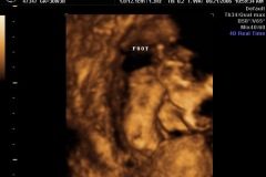 Kathryn's foot (4D)